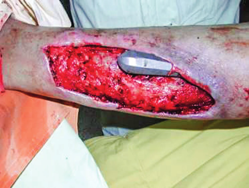 Same patient after surgical debridement of the wound. Note the deep undermining of the wound