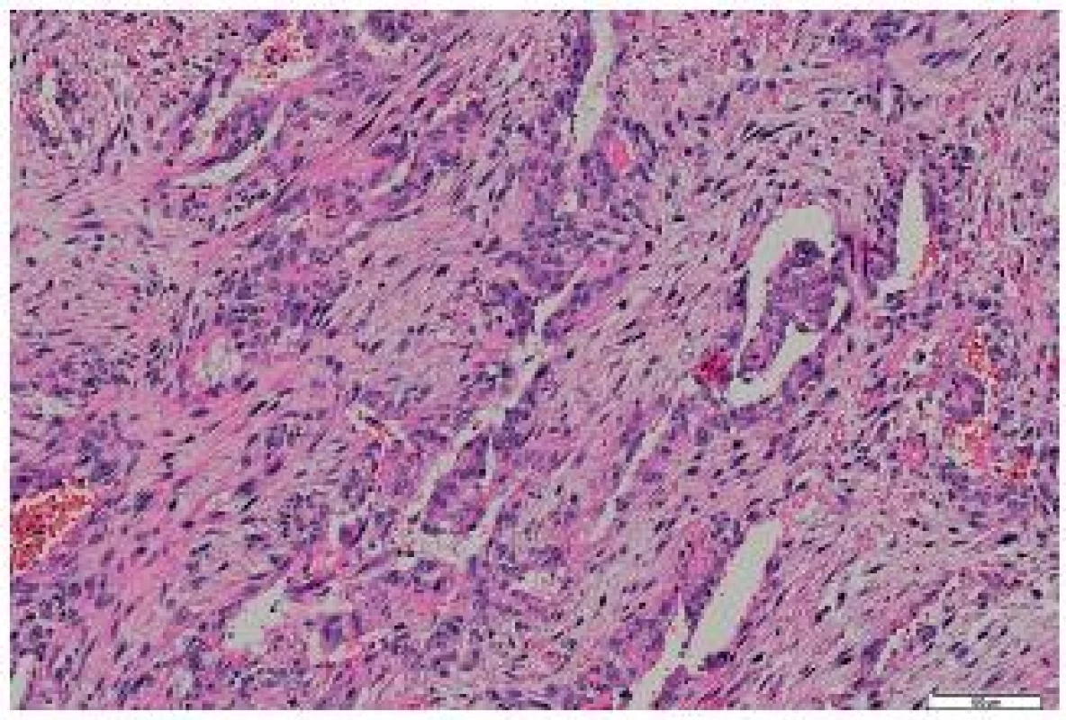 Metastasis of the tumor to the heart – biphasic structures were present in some portions. HE, scale bar 100 μm.
