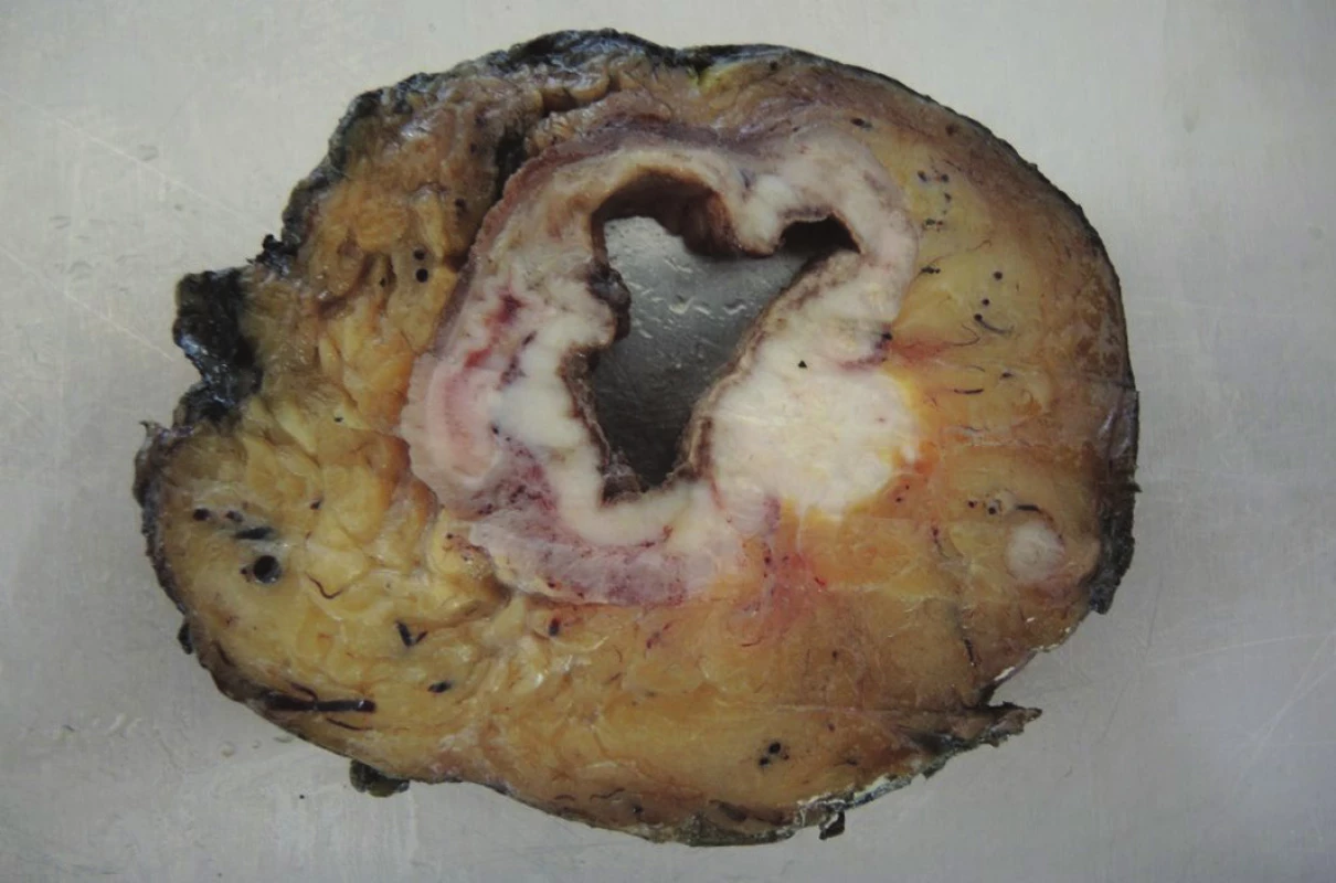 Příčná lamela resekátu v místě nádoru
Fig. 4: Transverse lamella of the resection specimen at the tumour site