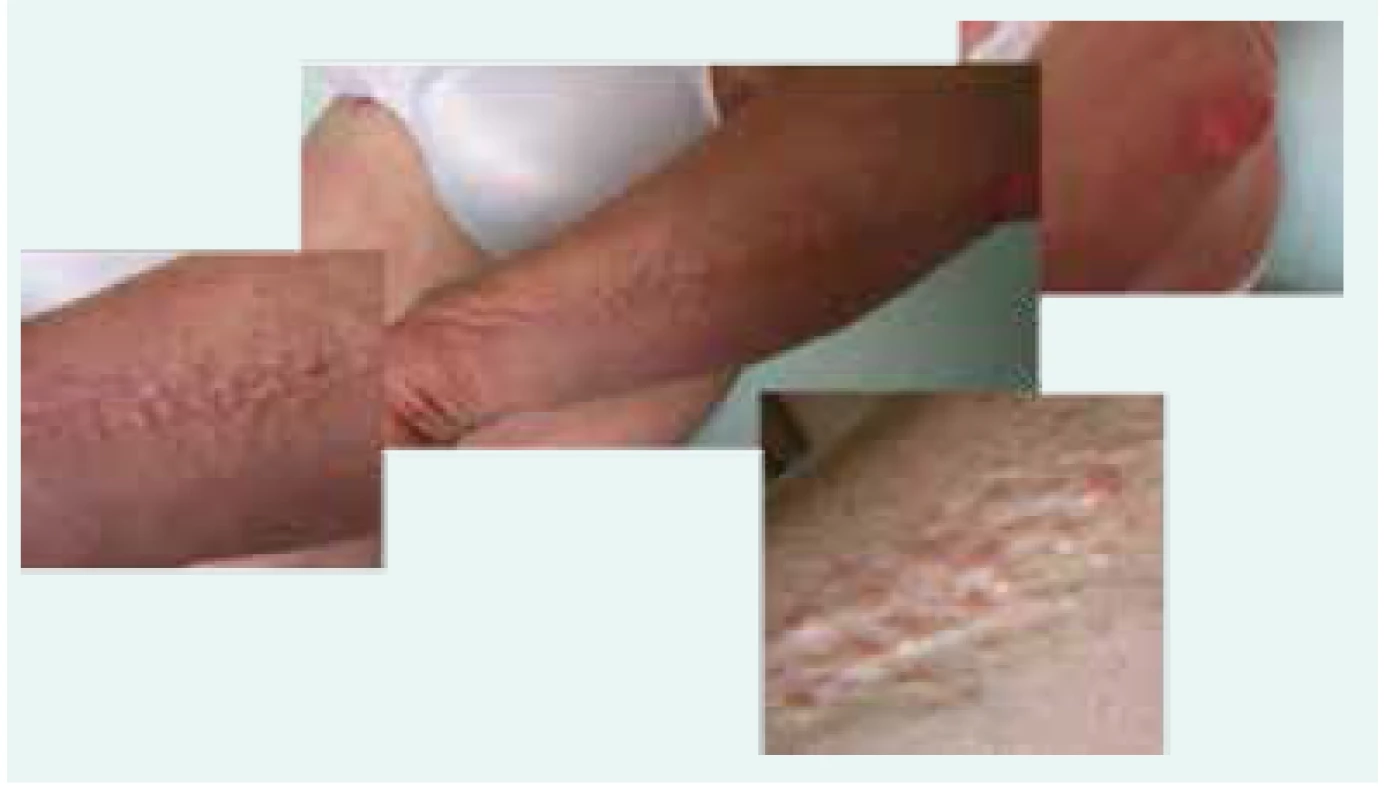 Fotografie kůže pacientky se skleromyxedémem: dobře patrná je lineární konfigurace papul