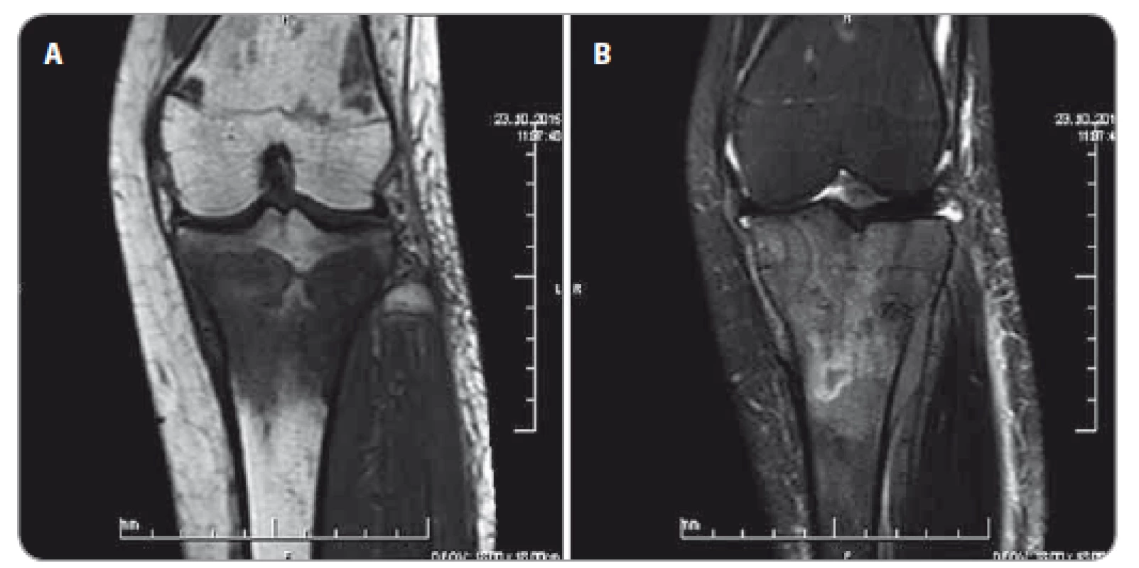 MRI ľavej tíbie – chaoticky nehomogénne zmenený signál – expanzia proximálnej epi-meta-diafýzy tíbie s mäkkotkanivovou zložkou (október 2015).