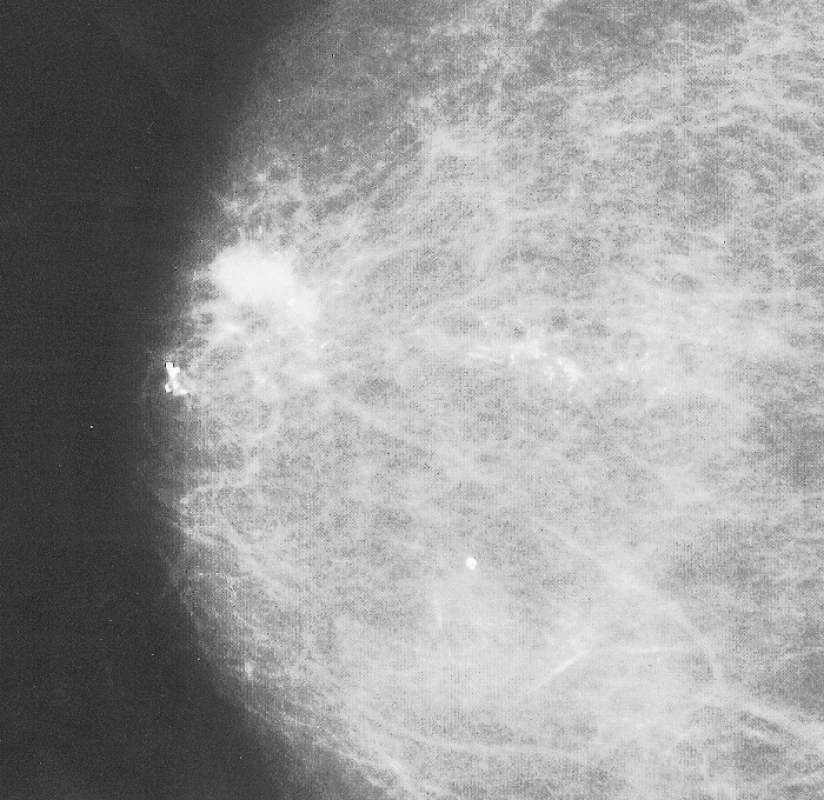 Mammogram pravého prsu: maligní léze s mikrokalcifikacemi
a satelitním ložiskem