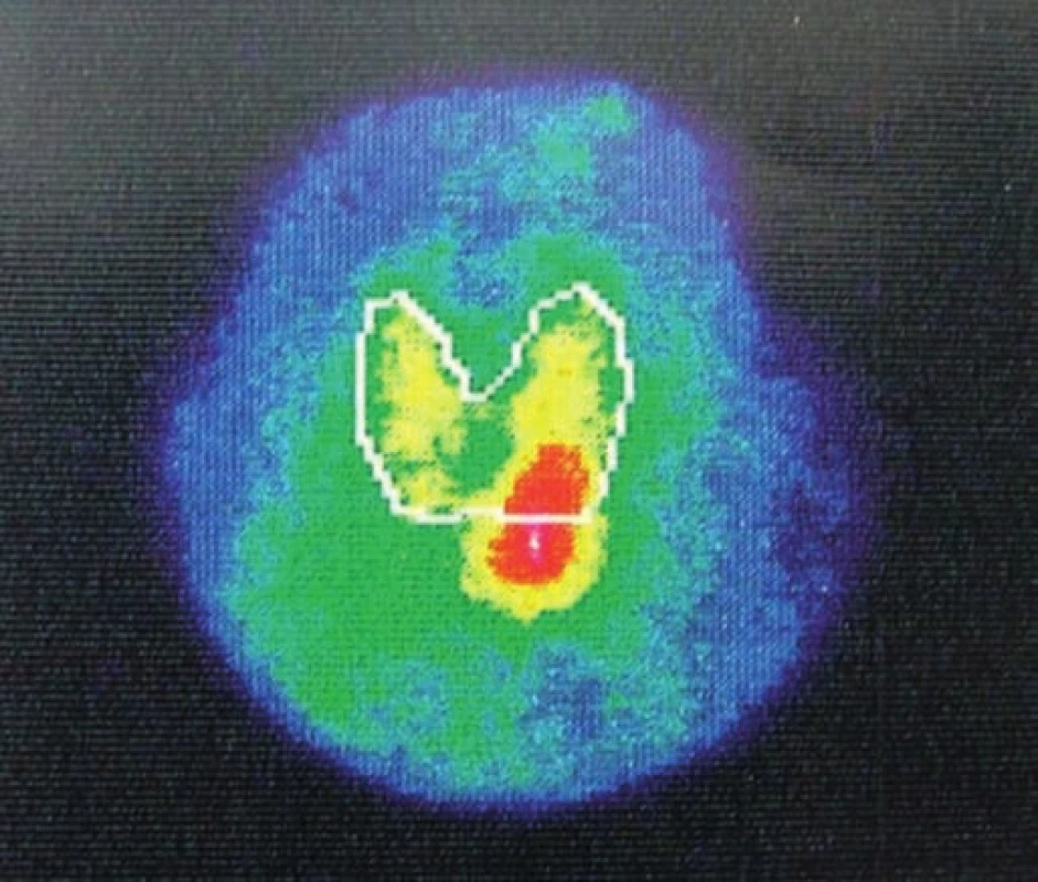Scintigrafia štítnej žľazy a prištítnych teliesok – hypoechogénne ložisko pod dolným pólom ľavého laloka štítnej žľazy. 
Fig. 4. Nuclear scan of the thyroid and parathyroid glands – a hypoechogenic structure at the lower pole of the left lobe of thyroid gland.