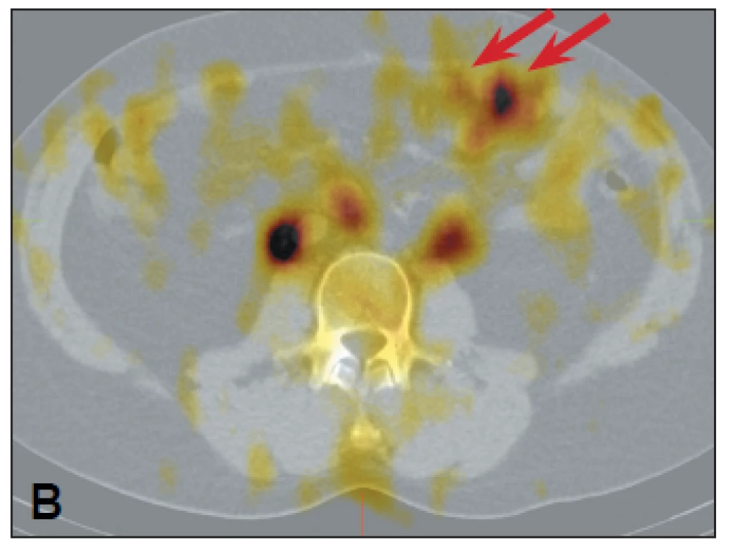 <i>Scintigrafie <sup>99m</sup>Tc značenými denaturovanými erytrocyty – laločnatá akumulace v levém mezogastriu ventrálně odpovídající nálezu na CT</i>