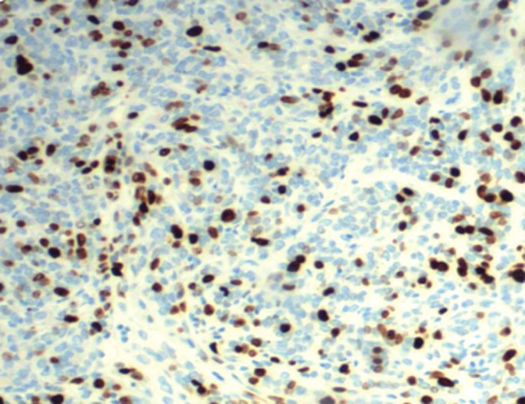 Imunohistochemické vyšetrenie proliferačnej aktivity buniek (Ki-67 indexu) pri nodulárnom type bazocelulárneho karcinómu. Výrazne sa farbia jadrá nádorových buniek v aktívnej rastovej fáze v celkovom rozsahu približne 30 % (DAKO, zväčšenie 800×).