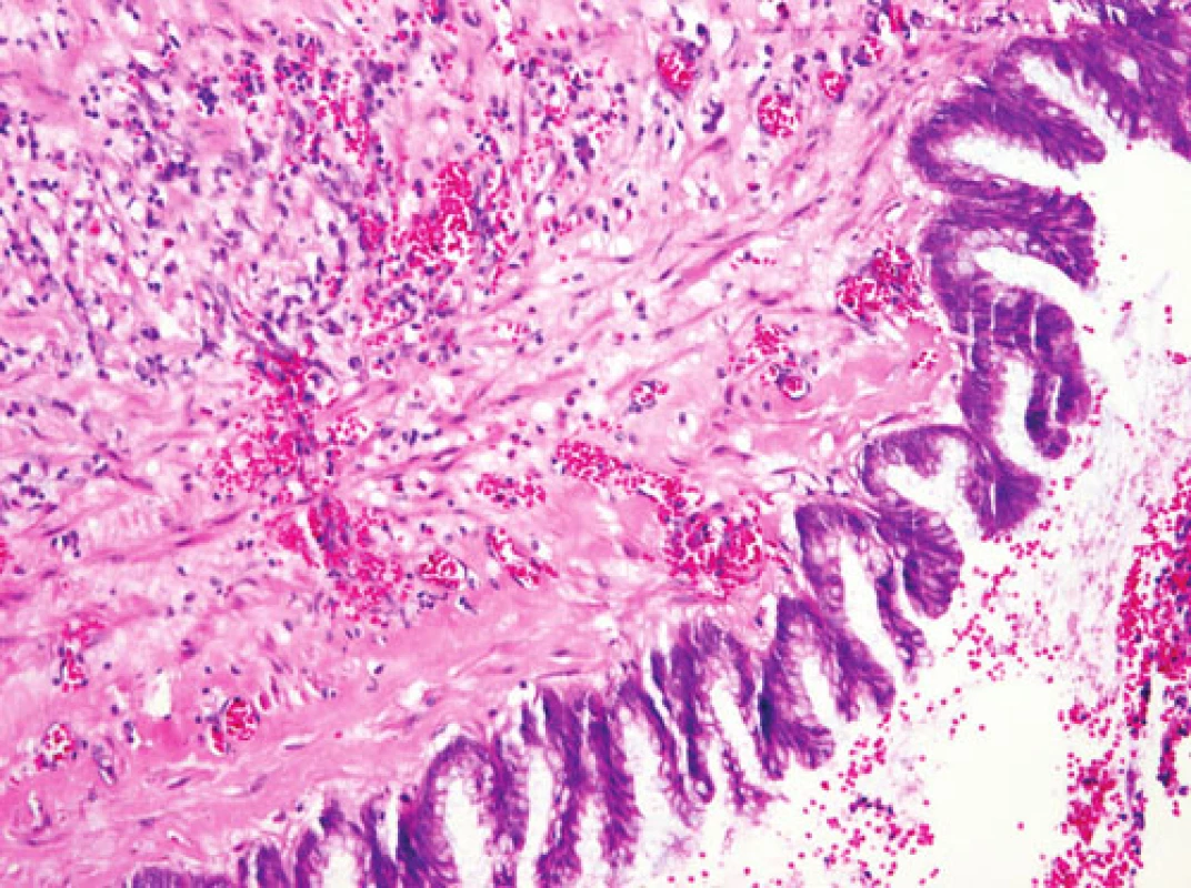 Dysplazie vysokého stupně v epitelu vystýlajícím lumen appendixu (HE, 120x)
Fig. 3. Severe dysplasia of the epithelium lining the appendiceal lumen (HE, 120x)