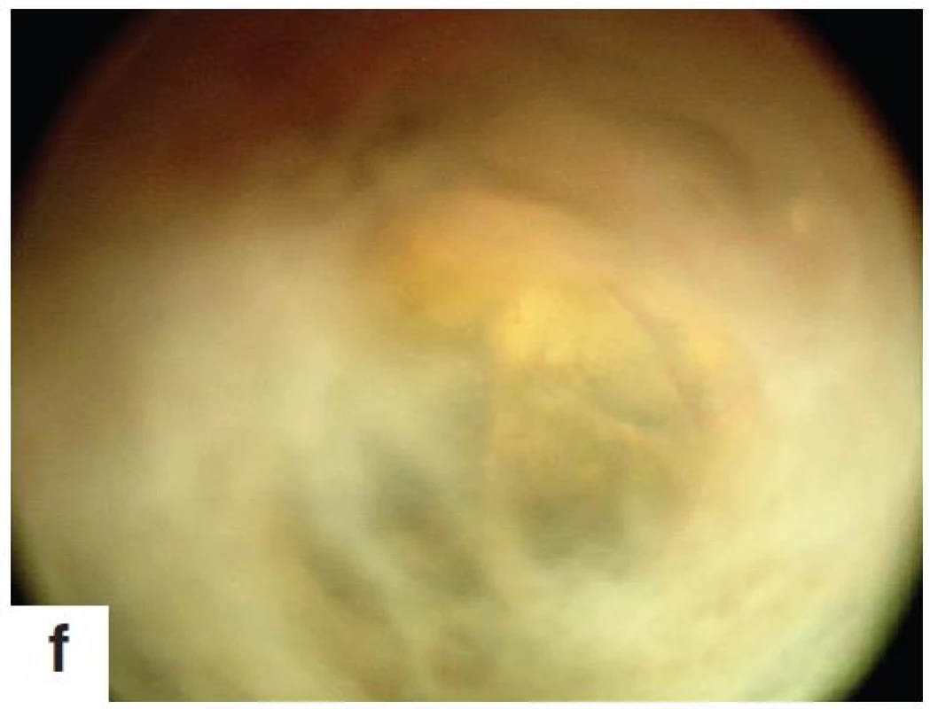 Vývojová stadia ROP (retinopathy of prematurity) – fotodokumentace pořízená ve Fakultní nemocnici v Ostravě digitálním zobrazovacím systémem RetCam 3. Snímek nezralé vaskularizace sítnice – progresivní zužování sítnicových cév směrem do periferie (obr. 2a), ,,plus disease“ forma ROP – dilatované a vinuté cévy (obr. 2b), ROP 1. st. – demarkační linie oddělující vaskularizovanou a avaskulární část sítnice (obr. 2c), ROP 2. st. – elevace demarkační linie a vytvoření tzv. valu (obr. 2d), ROP 3. st. – hřebenovité vyvýšení demarkační linie s neovaskularizacemi a počínající extraretinální fibroproliferaci (obr. 2e), ROP 4. st. – částečné odchlípení sítnice, ROP 5. st. - terminální stadium – totální odchlípení sítnice (obr. 2f)