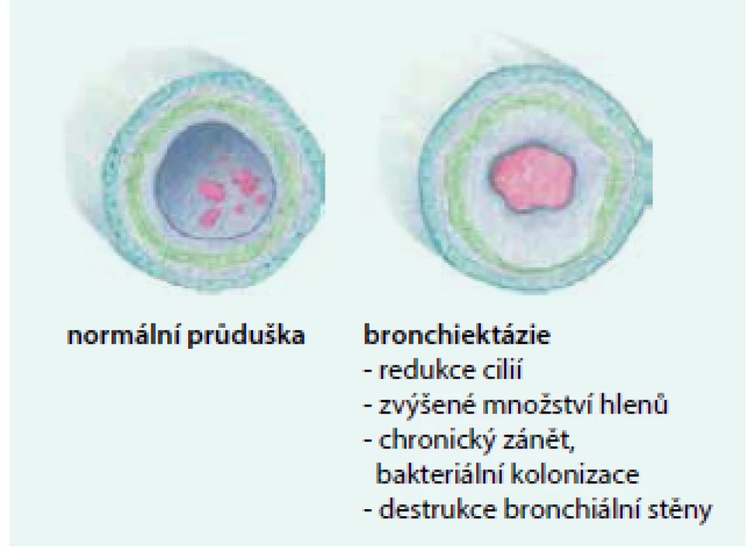 Patogeneze destrukce bronchiální stěny: morfologický rozdíl mezi zdravou průduškou (vlevo) a bronchiektatickou průduškou (vpravo).