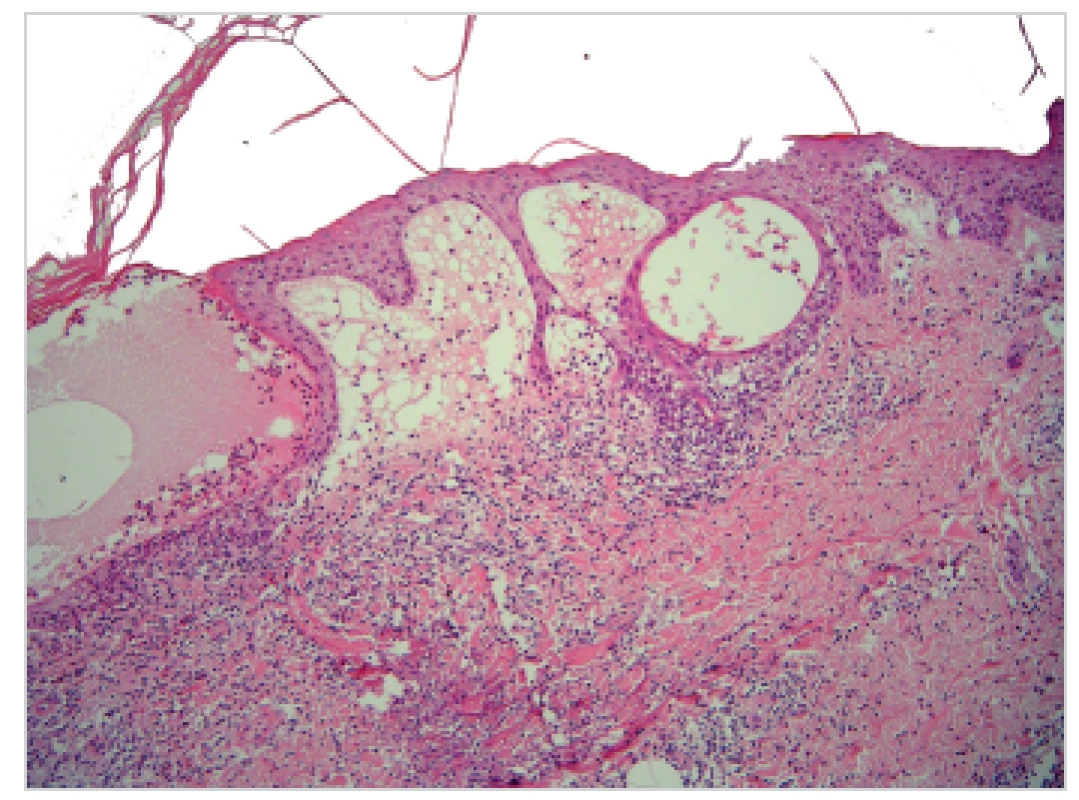 Subepidermální a intraepidermální buly, v koriu bohatý infiltrát lymfocytů a eozinofilů, pod bulou v retikulárním koriu je flame figure – obraz odpovídající Wellsovu syndromu