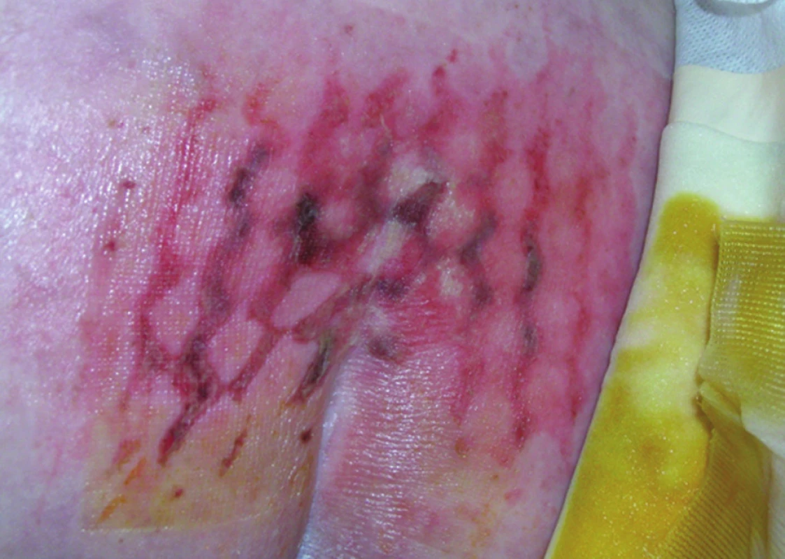 Dekubitální změny na kůži u nemocného po TPE
Fig. 1: Decubital skin changes in a patient after TPE