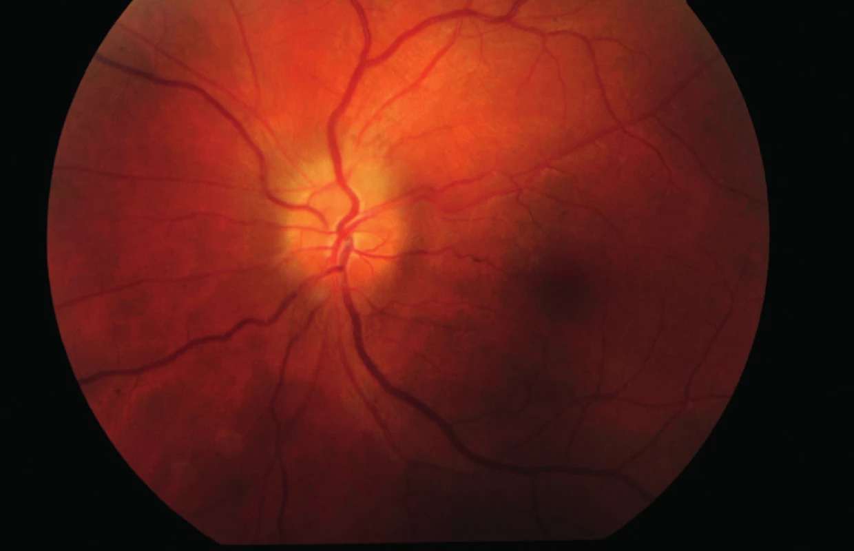 Očné pozadie ľavého oka (7/2013) – edém papily zrakového nervu.
