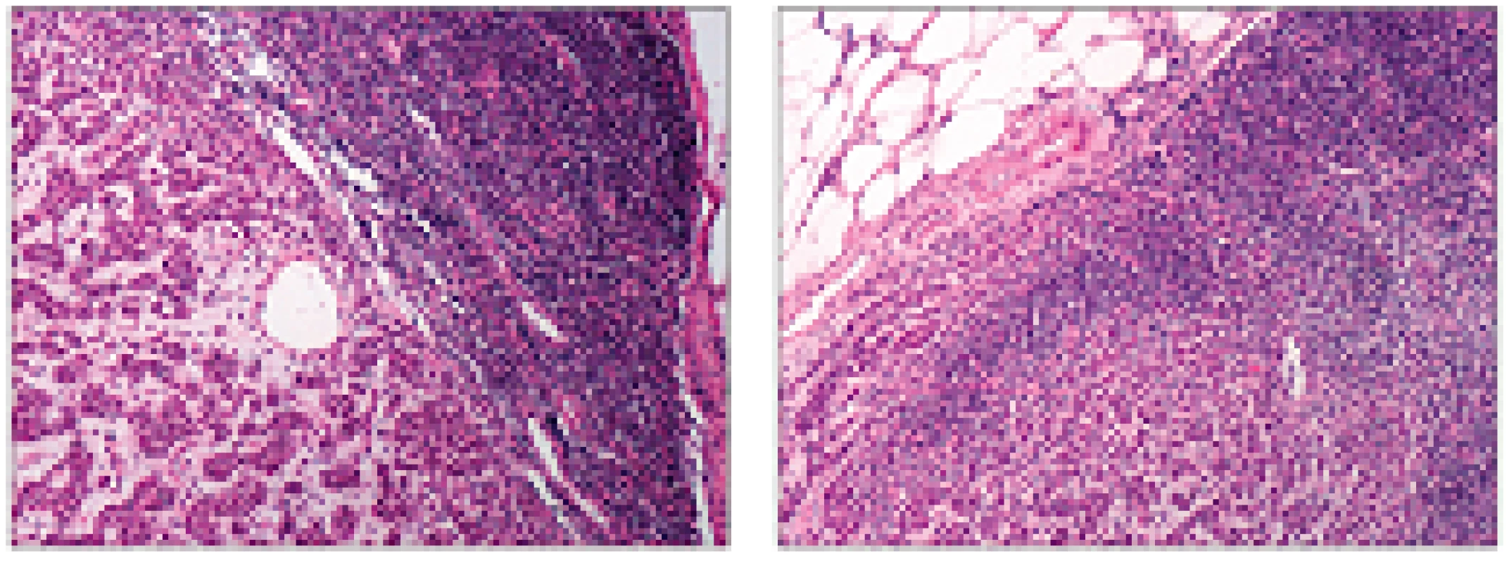 Dvě ukázky histologického obrazu (řezů) metastázy duktálního karcinomu prsu do sentinelové uzliny, barvené hematoxylinem a eosínem.