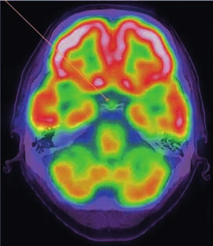 PET-CT mozku, axiální řez