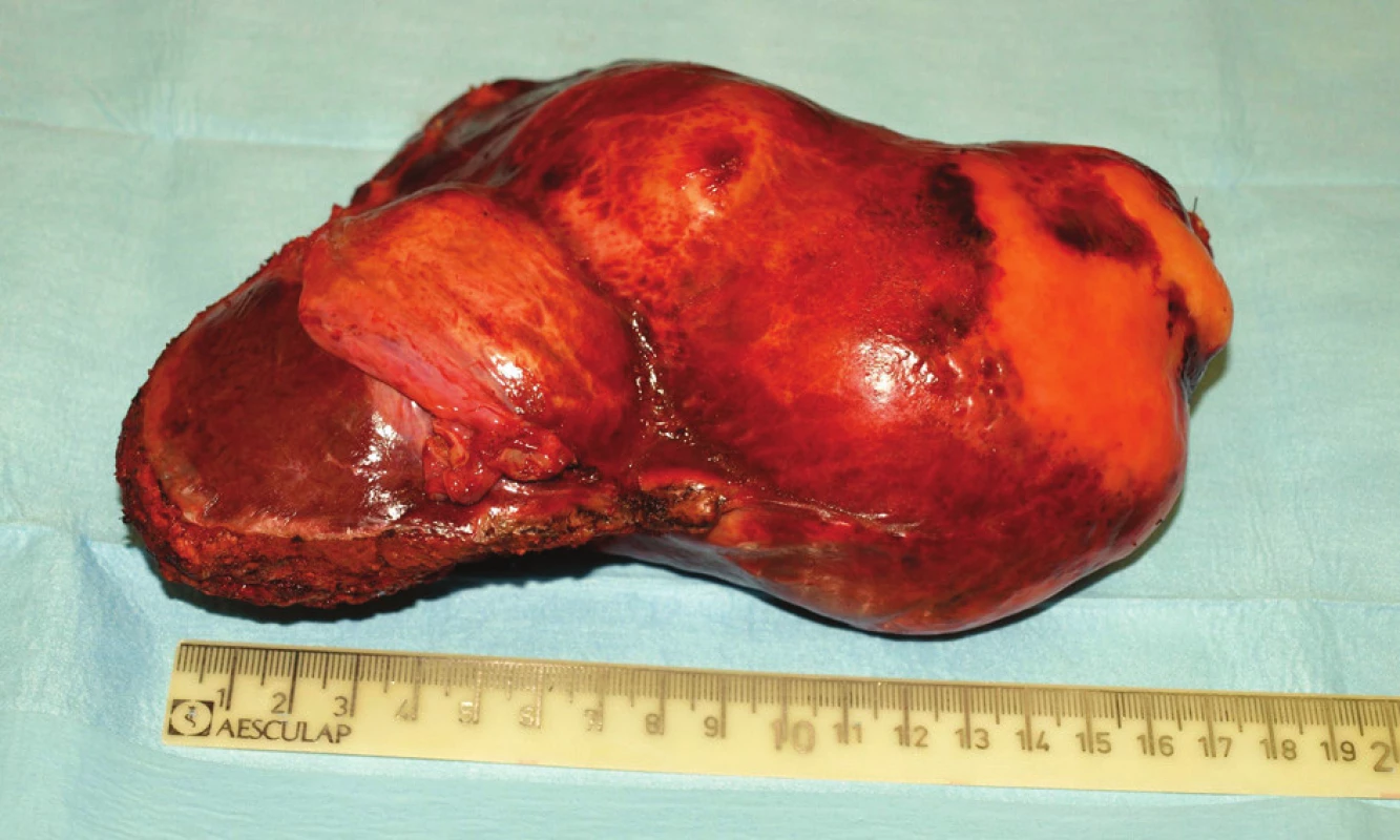 Resekát části levého laloku jater s vyklenujícím se pouzdrem nad parazitární cystou
Fig. 2: Resected part of the left hepatic lobe with an arching case over the parasitic cyst