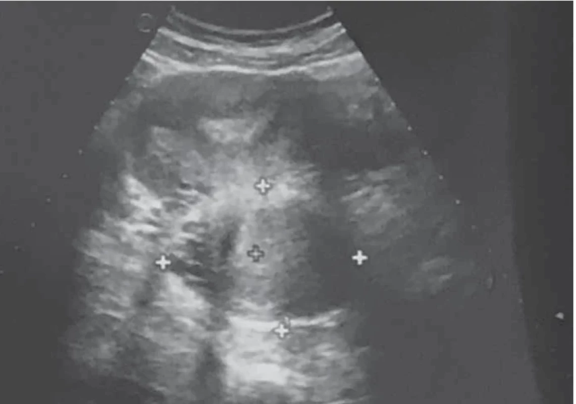 Axial view of abdominal-pelvic ultrasound showing the cervico-isthmic neoformation on the left posterior wall. // Axiální pohled při ultrazvuku břicha a pánve, který ukazuje cervikoistmický novotvar na levé zadní stěně.