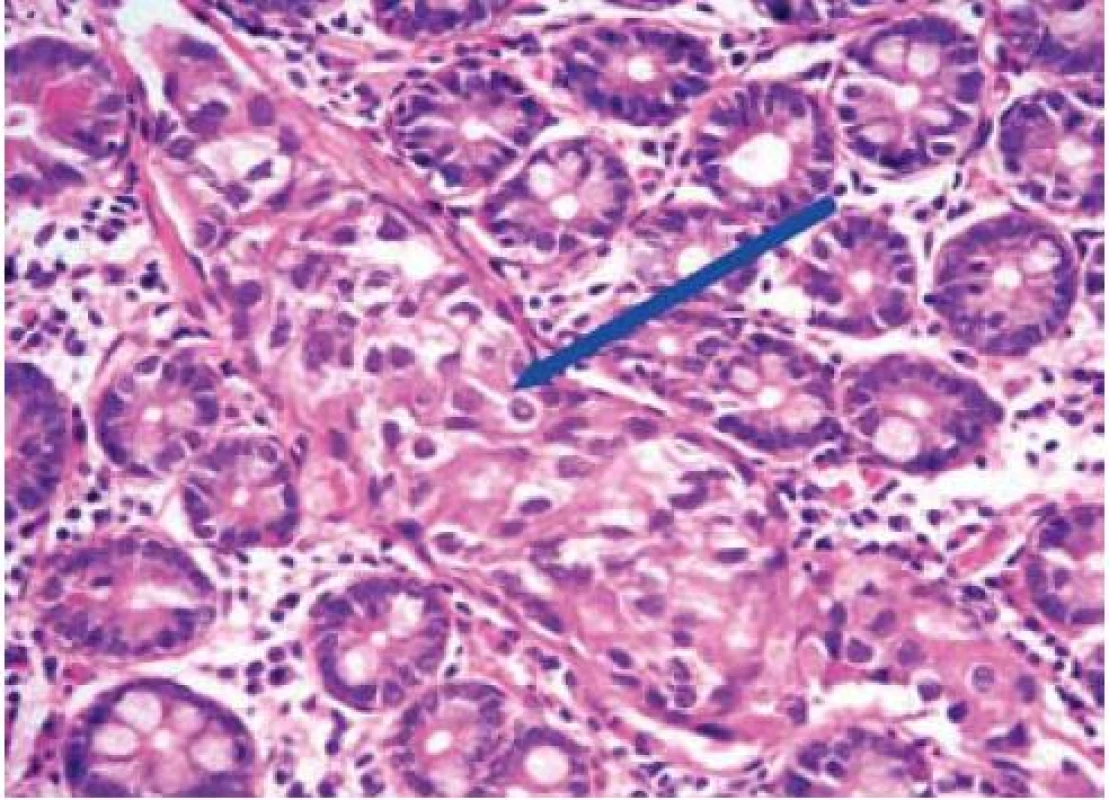 Lymfagioinvaze – struktury karcinomu patrné uvnitř lymfatické cévy – viz šipka.
Fig. 2. Lymphatic vessel invaded by carcinoma – see arrow.