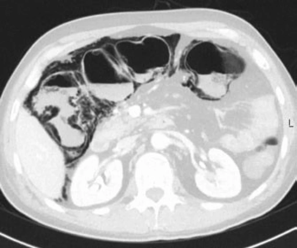 CT, transverzální řez, plicní okno. Plyn ve stěně tračníku v oblasti hepatální flexury, pneumoperitoneum a pneumoretroperineum v oblasti pravé ledviny.