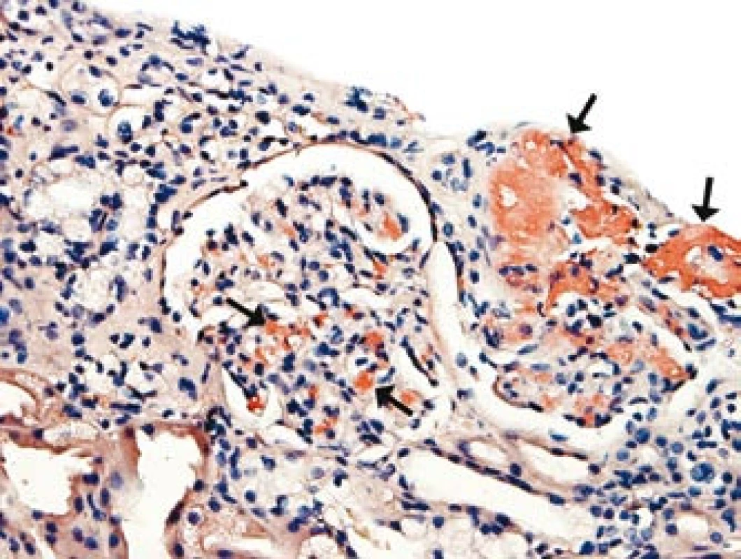Depozita amyloidu v mesangiu ledvinného glomerulu a ve stěně arteriol (u šipek). 