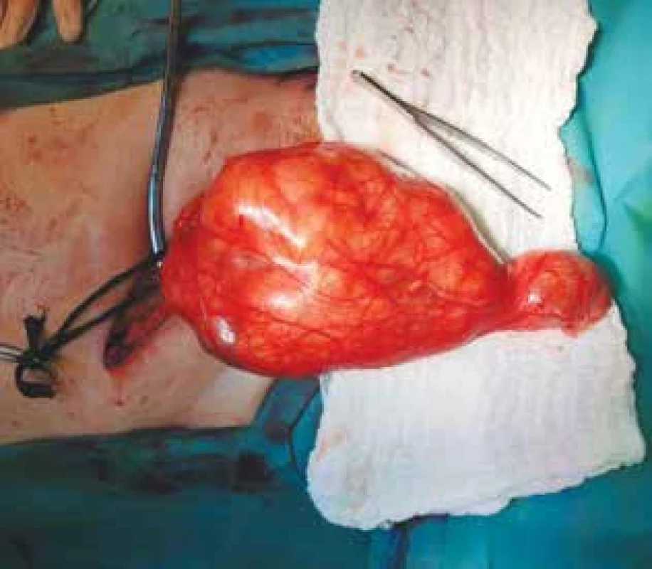 Perioperační nález: luxace expanze s varletem do operační rány