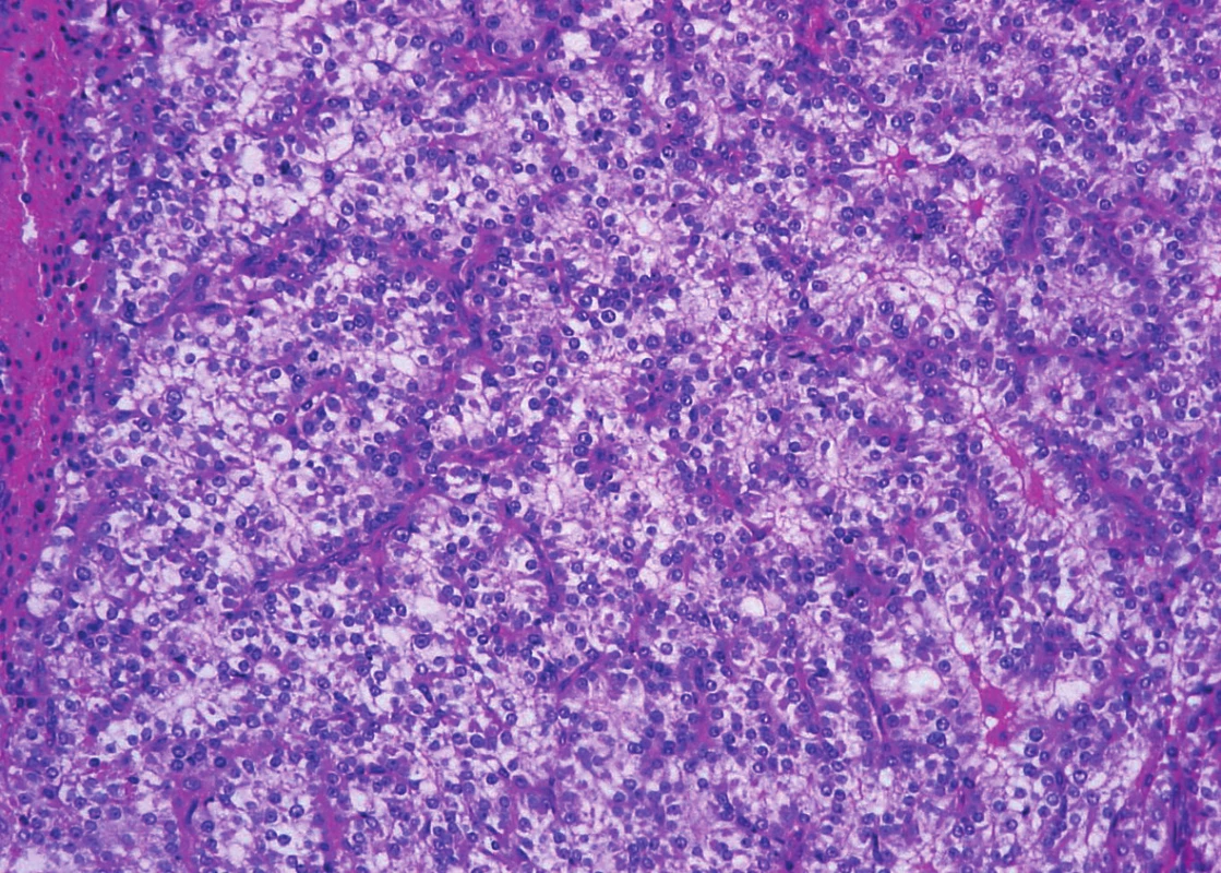 Parathyroid carcinoma. Neoplastic cells are columnar, with clear cytoplasm and with regular vesicular nuclei (hematoxylin and eosin, magnifications x 200).