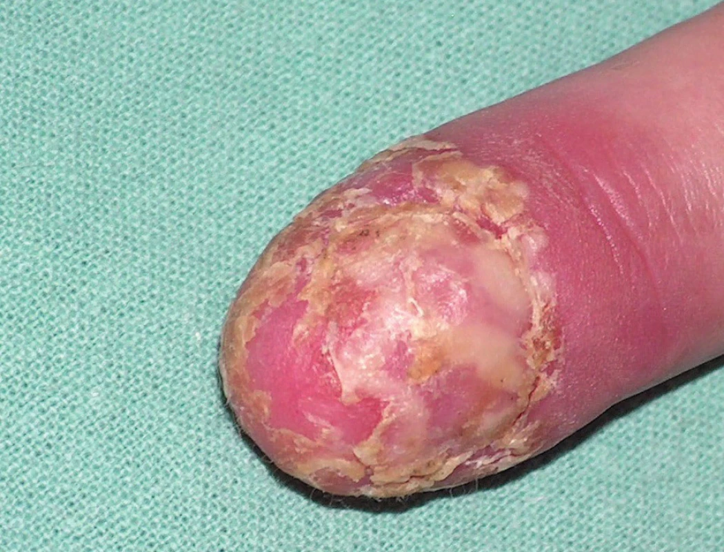 Acrodermatitis continua suppurativa (Hallopeau) (z archivu Dermatovenerologické kliniky 1. LF UK a VFN)