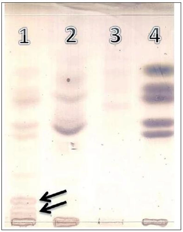 Tenkovrstvová chromatografia (TLC) oligosacharidov moča. Dráha 1: pacient – GM1 gangliozidóza, dráha 2 a 3: normálny profil oligosacharidov v moči, dráha 4: referenčná – štandardy (od vrchu dole), xylóza/glukóza/galaktóza/laktóza/rafinóza. Abnormálne frakcie oligosacharidov typické pre GM1 gangliozidózu sú indikované šípkou.
Fig. 3. Thin-layer chromatography (TLC) of urinary oligosaccharides:
Track 1: patient – GM1 gangliosidosis, tract 2 and 3: normal profile of oligosaccharides in urine, track 4: reference standards (from top to bottom), xylose/glucose/galactose/lactose/raffinose. Abnormal fractions of oligosaccharides typical for GM1 gangliosidosis are indicated by arrow.