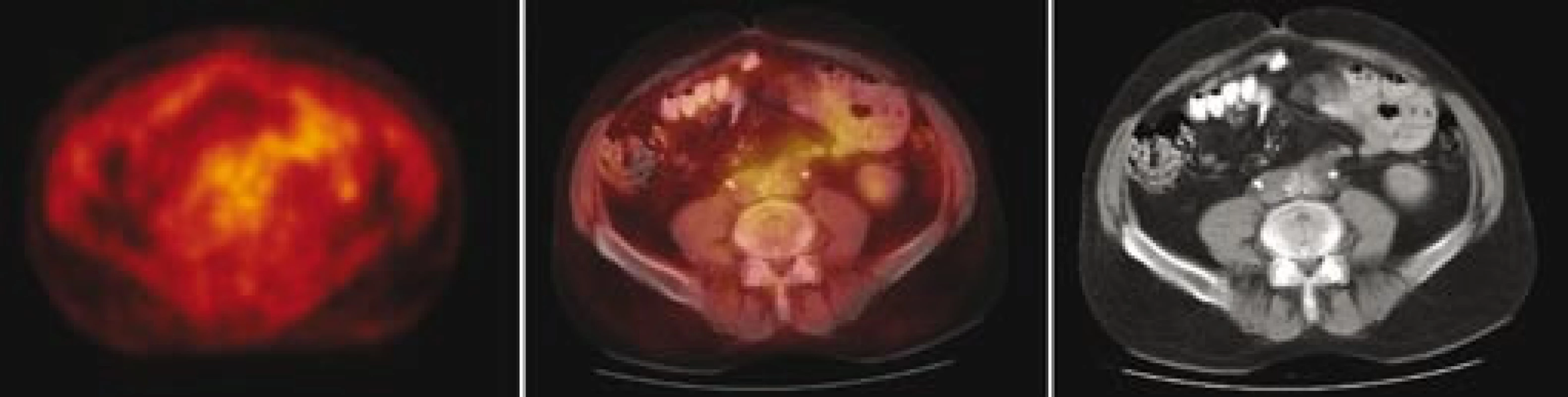 Fúze PET/ CT– transverzální řezy ve výši bifurkace aorty: vlevo obraz PET v barevné škále hot body, uprostřed fúzovaný obraz 50 % PET a 50 % CT, vpravo CT. Na PET patrné vymizení hypermetabolizmu glukózy v měkkotkáňovém infiltrátu periaortálně, na CT patrné zmenšení rozsahu retroperitoneálního infiltrátu. Stenty v obou ledvinách, aktivita PET jen v ledvinách a ureterech – odpovídá vylučování radiofarmaka.