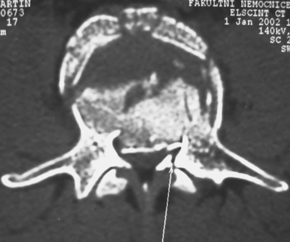 Axiální CT řez pincer burst zlomeniny obratlového těla typ A2.3
Pic. 2. Axial CT view of the pincer burst vertebral body fracture, type A2.3