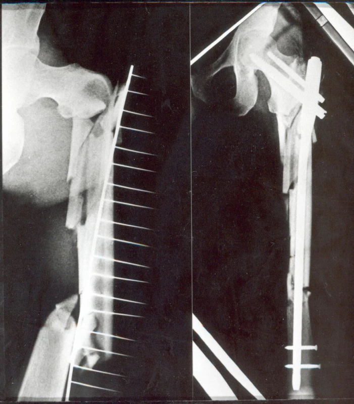 Pacient, 40 let, s tříštivou zlomeninou jdoucí od tuberculum innominatum až značně distálně do diafýzy (typ VI.) a) úrazový snímek, b) stav po osteosyntéze zlomeniny PFN, postavení fragmentů je velmi dobré