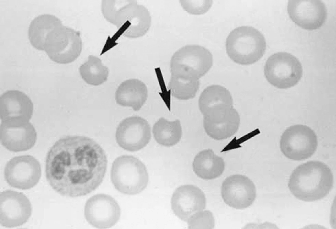 „Okousané“ erytrocyty (bite cells) u pacienta s deficitem glukózo-6-fosfát dehydrogenázy v hemolytické krizi.