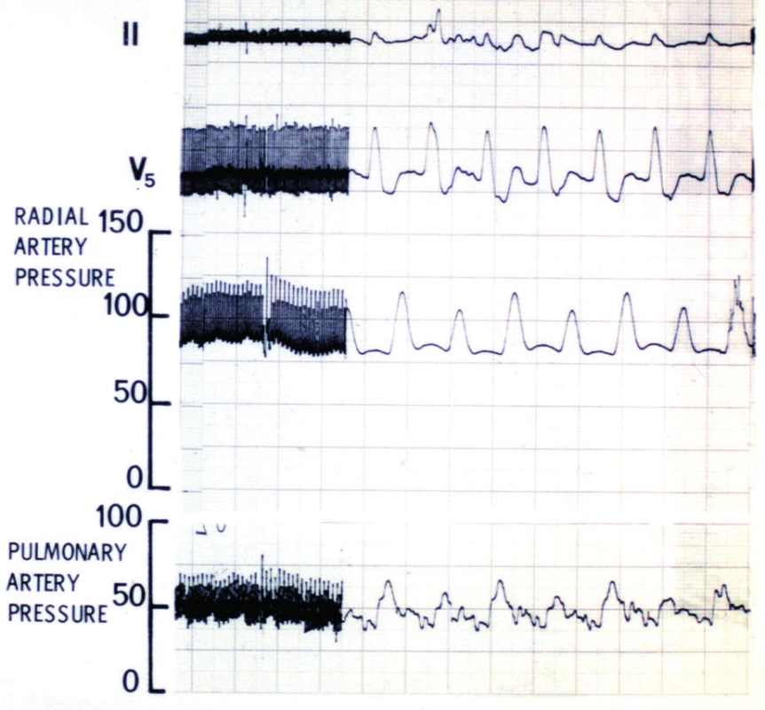 Záběr kontinuálního intraoperačního monitorování EKG a tlakových křivek