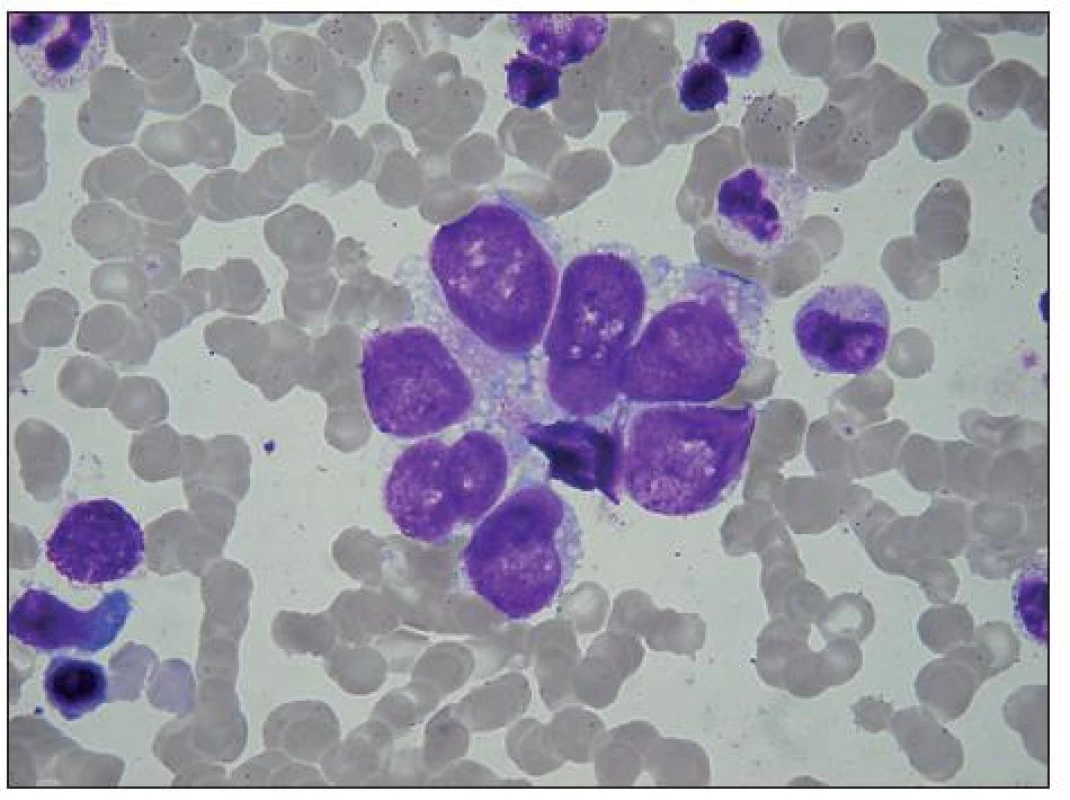 Malý rozetoidní trs rhabdomyoblastů v KD. Buňky s velkým jádrem, cytoplazma je vakuolisovaná a stejně jako na předchozím obrázku je na periferii bazofilní, perinukleárně acidofilní. Buňky v horní části splývají, snad jde o jednu vícejadernou buňku. V levé dolní části shluku je dvoujaderná buňka, v levém dolním rohu holé jádro, plazmocyt a bazofilní normoblast.