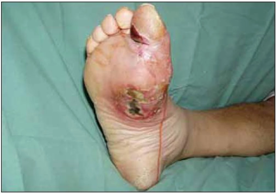 Ischemické postižení palce pravé dolní končetiny s vlhkou gangrénou a pronikáním infekce do plosky podél palmární aponeurózy. Nemocná byla v této době septická.