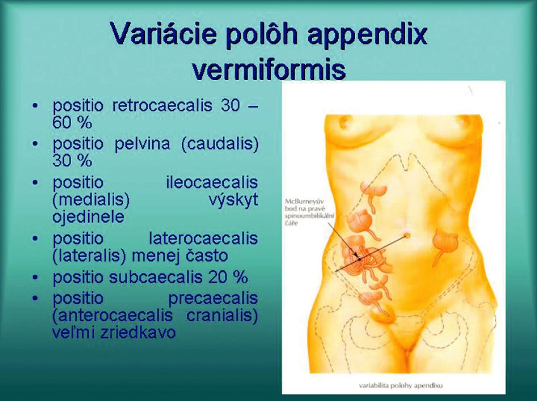 Variabilita polohy apendix vermiformis
Fig. 1. Variability of the appendix vermiformis location