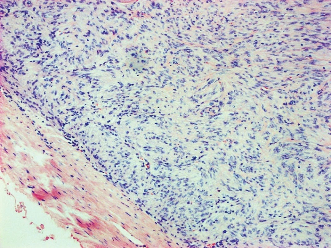 GIST of the duodenum, HE, 100x