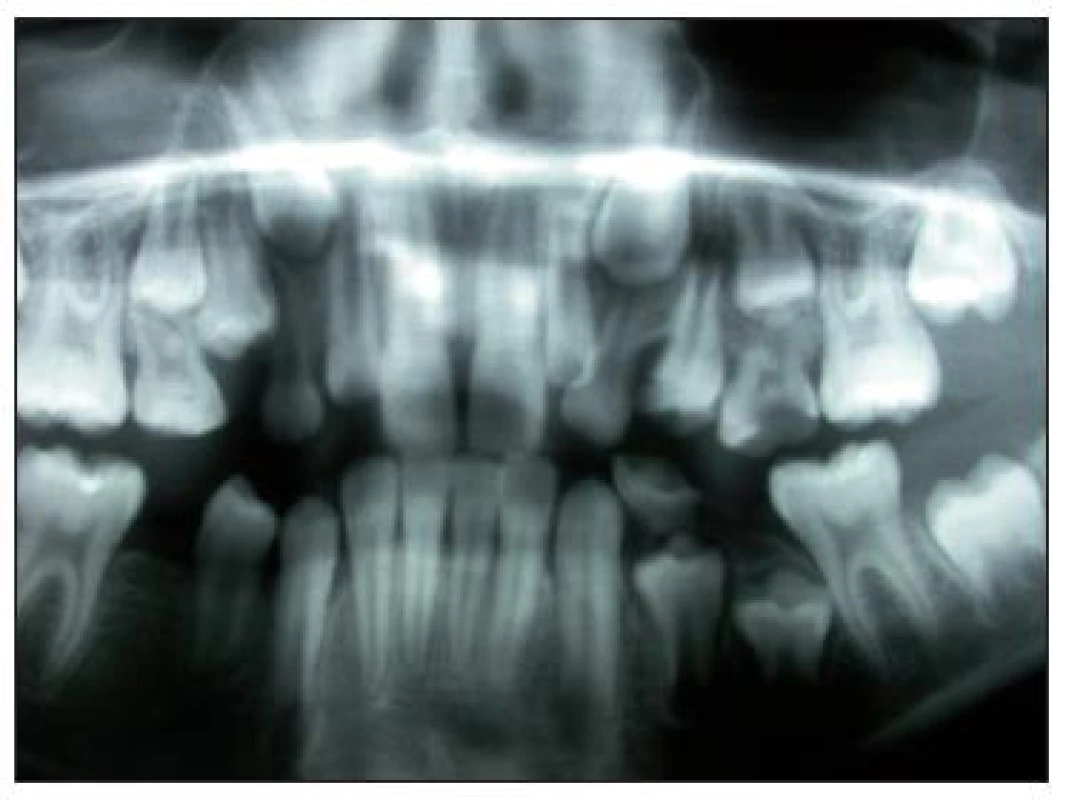 Ortopantomogram v průběhu erupce zubu 24.