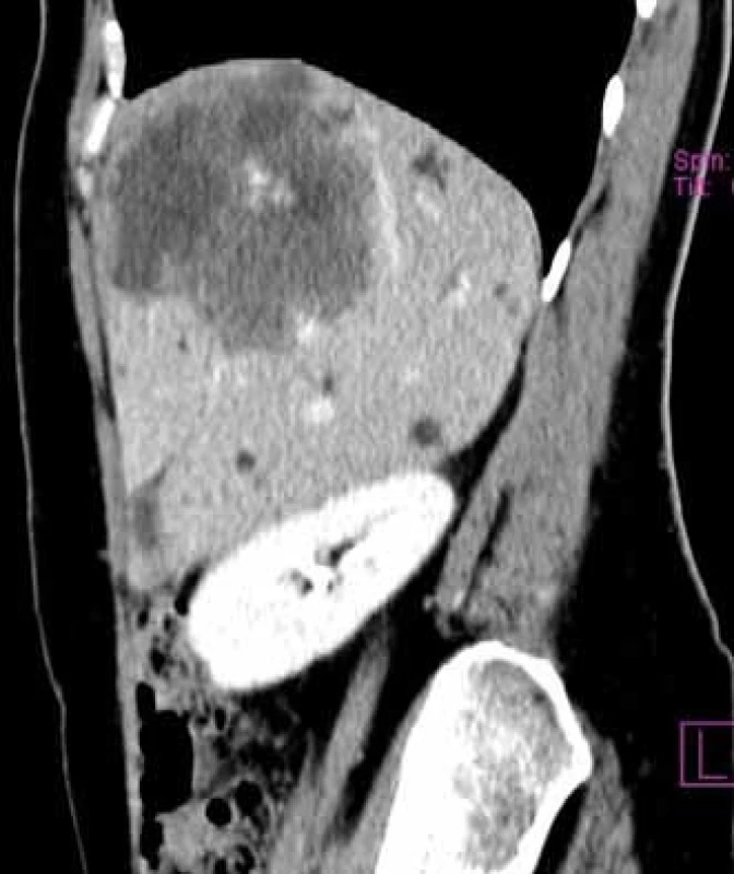 CT s kontrastom – sagitalna rekonštrukcia.
Fig. 2. CT scan with contrast. Sagittal reconstruction.