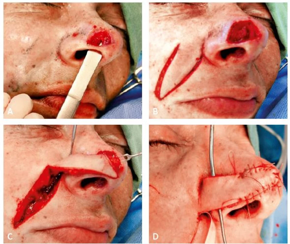 A–D. Sequence of reconstruction of a penetrating defect of the nasal tip with interpolation nasolabial flap in combination with nasal mucosal advancement
