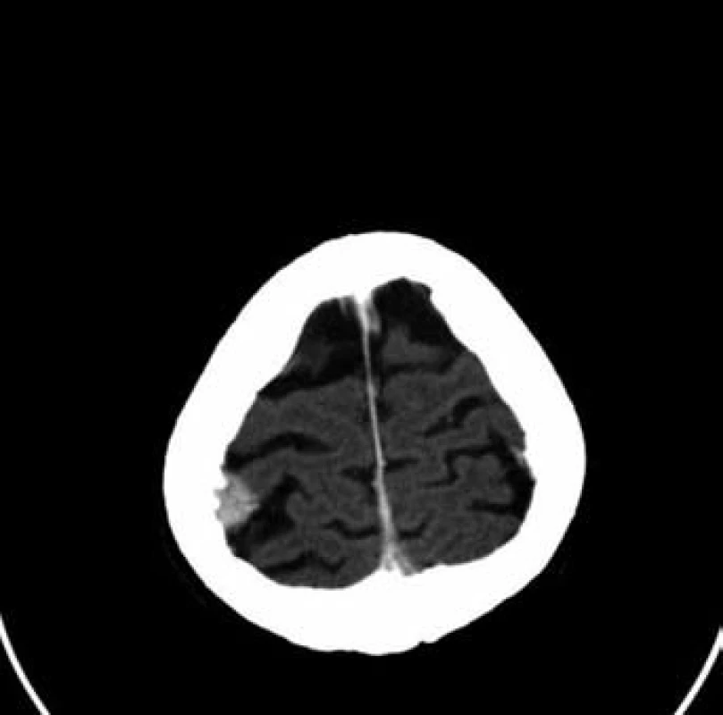 Patologické ložisko ve skeletu kalvy vpravo (mozek)