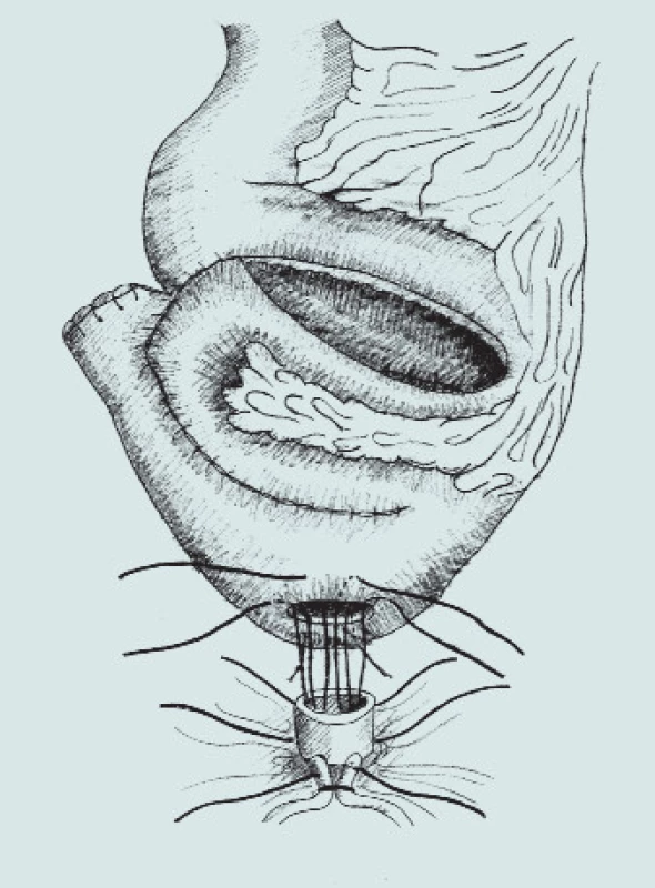 Náhrada močového měchýře - schéma ortotopické ileální neoveziky a napojení na stávající uretru.