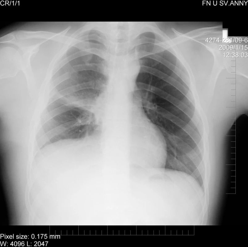 Výsledný rentgenový pooperační snímek plic
Fig. 6. The final chest X-ray after the radical surgery