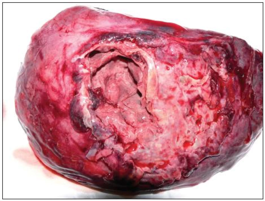 Horní lalok pravé plíce s píštělí (kazuistika č. 2)
Fig. 3. Fistula of right superior pulmanory lobe (case report No. 2)
