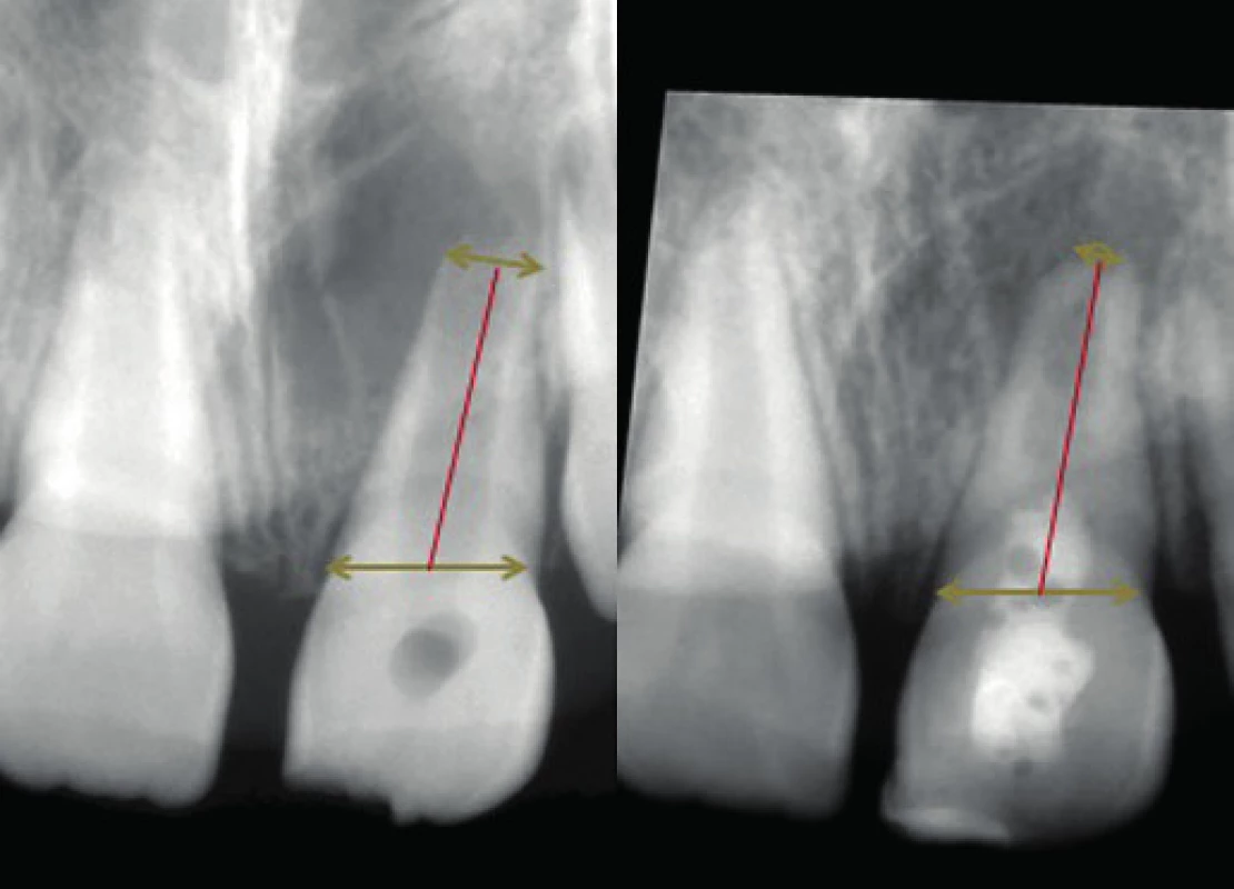 Diagnostický snímek a upravený kontrolní snímek. Na obou je vyznačena radiologická délka kořene.