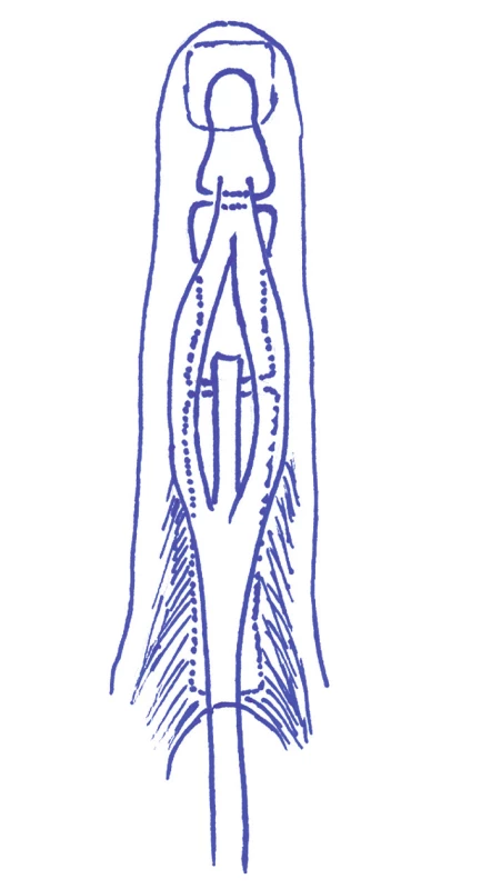 Schéma distální části extenzorového aparátu prstu. Centrální pruh se upíná na bázi středního článku, postranní pruhy na bázi článku distálního.
