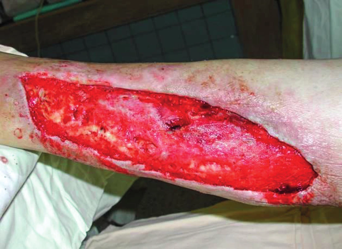 Wound appearance after 5 days of NPWT immediately before wound closure procedure. The undermined space is almost obliterated, wound surface covered by healthy granulation tissue
