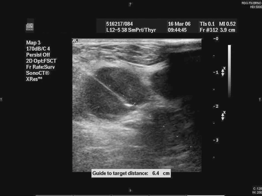 Fotografie z ultrazvukem řízené punkce axilární uzliny.