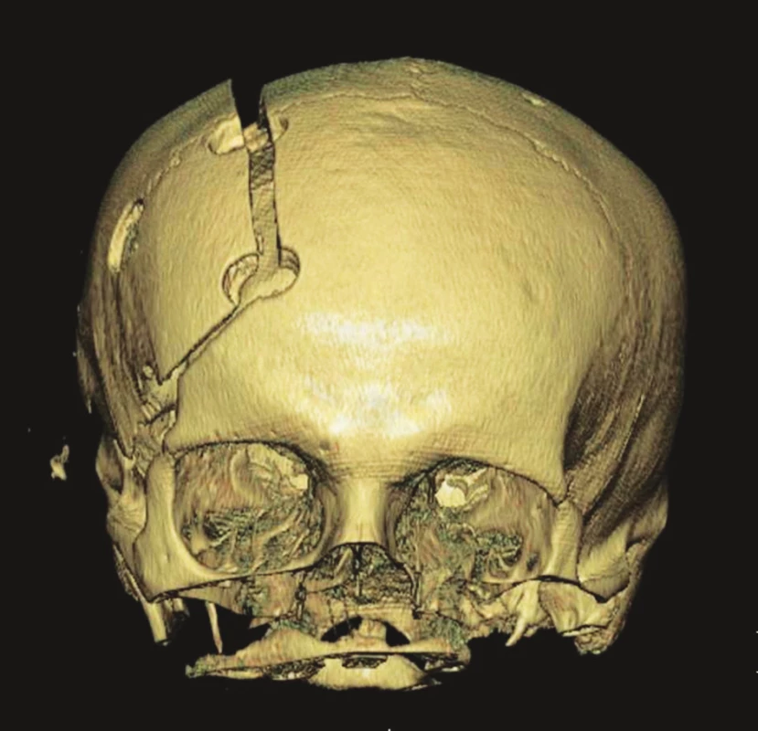 Nadzdvižená kostní ploténka ve stadiu edému mozku
Fig. 3. Cerebral edema lifting the bone plate