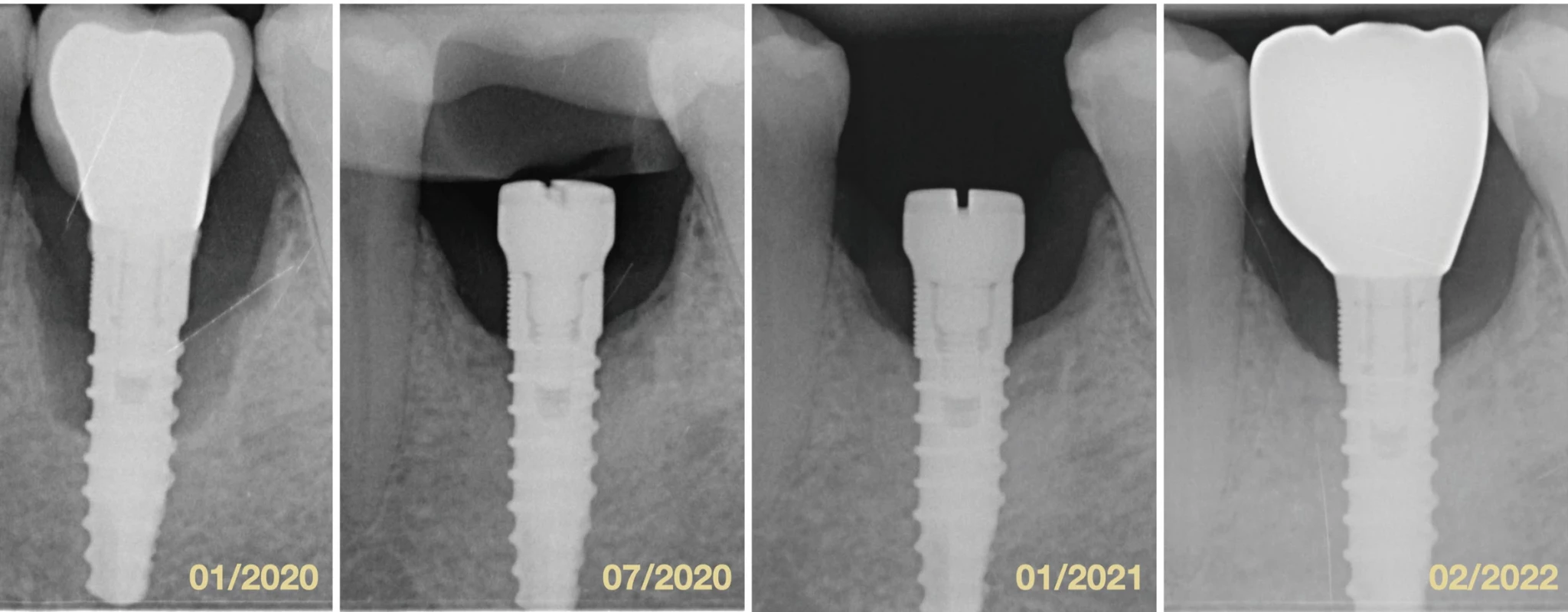 Porovnanie štyroch intraorálnych röntgenových snímok v horizonte dvoch rokov. </br>Fig. 3 Comparison of four intraoral X-rays in two-years period.