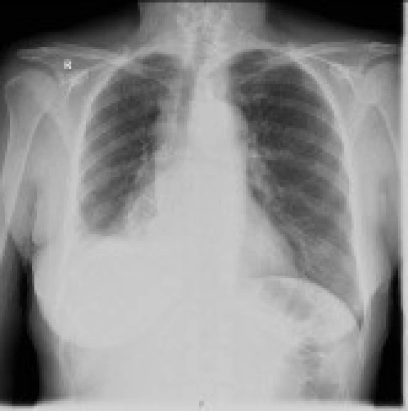 RTG srdce a plic s nálezem 5,5 cm velikého tumoru pod pravým plicním hilem, deviací průdušnice vpravo a fluidotoraxem vpravo.