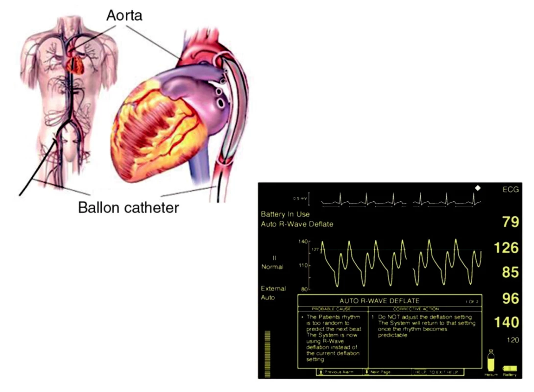 Intraaortální balonková kontrapulzace Vlevo – zavedení do descendentní aorty; vpravo – hemodynamický efekt na tlakové křivce z aorty – diastolická augmentace.